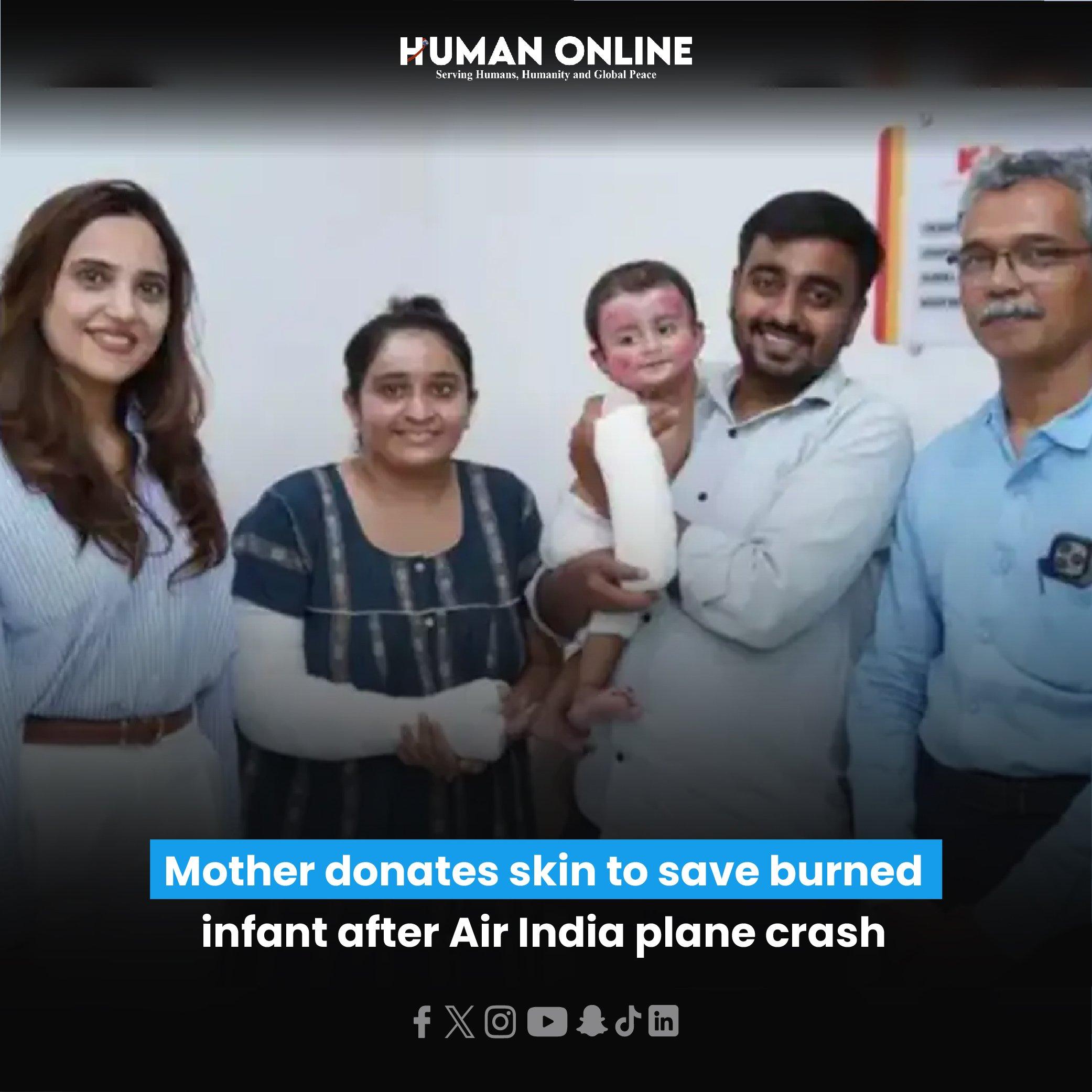 ایئر انڈیا حادثہ: ماں کی ممتا نے بچائی آٹھ ماہ کے دھیانش کی جان، خود کی جلد عطیہ کر کے بنیں ڈھال