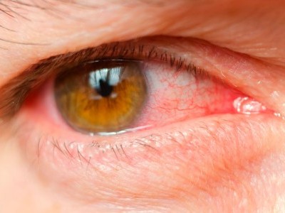 آشوب چشم، ایک وبائی مرض